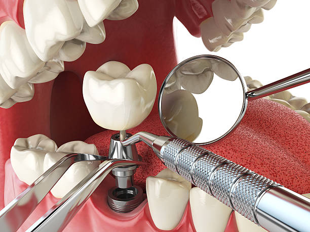 Best Emergency Denture Repair in Mankato, MN